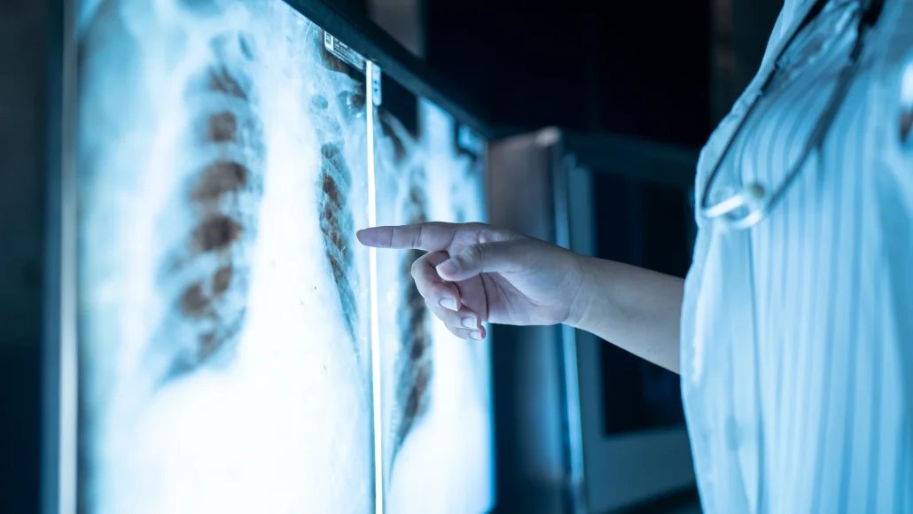 El cáncer de pulmón vuelve a ser el más común en el mundo