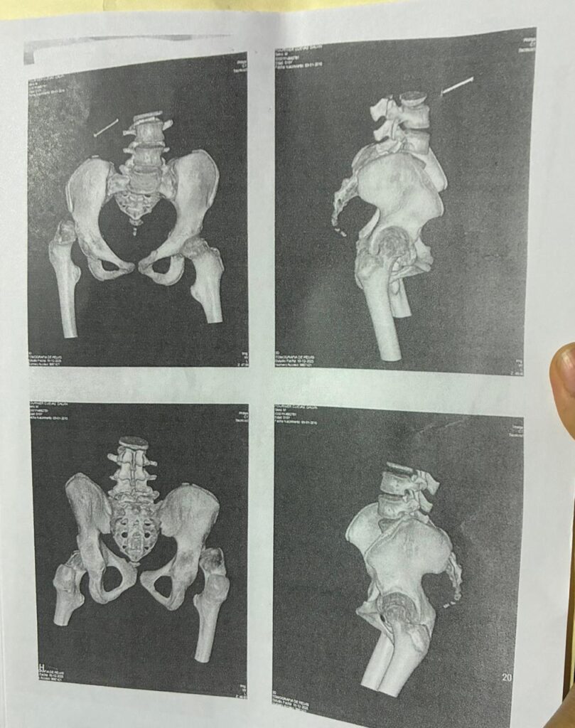 Madre solicita ayuda para costear cirugías de su hijo con parálisis cerebral - Noticias de hoy en República Dominicana | De Último Minuto