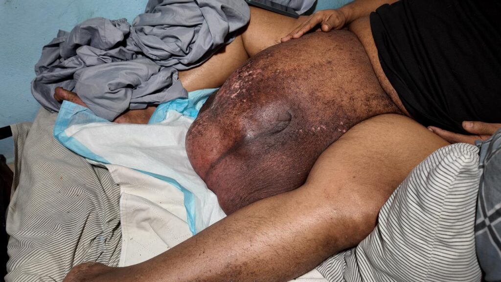 Joan Batista lucha contra tumor gigantesco que lo mantiene en cama; solicita ayuda para cirugía - Noticias de hoy en República Dominicana | De Último Minuto