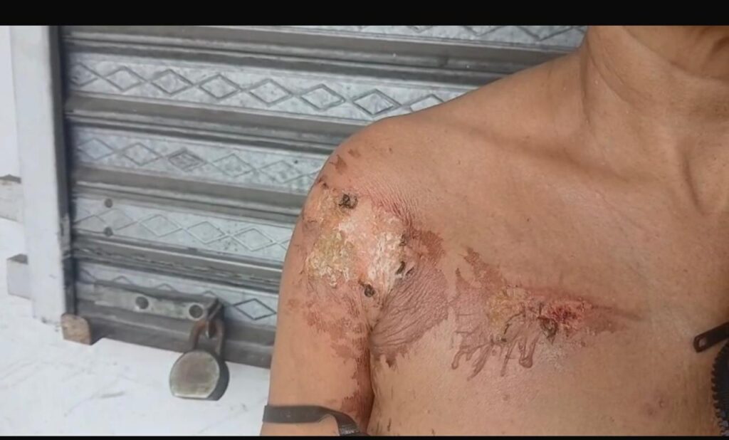 Mujer resulta con graves quemaduras tras ser atacada con aceite caliente por deuda de RD$1,000 en Moca - Noticias de hoy en República Dominicana | De Último Minuto
