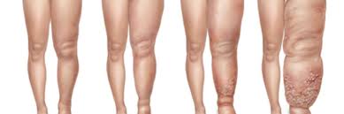 Día Internacional del Linfedema - Noticias de hoy en República Dominicana | De Último Minuto