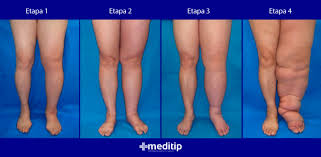 Día Internacional del Linfedema - Noticias de hoy en República Dominicana | De Último Minuto